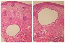 エクリン汗嚢腫 －その4　皮膚生検についてー