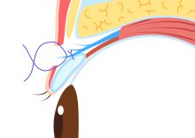 切開式重瞼術ではなく、眼瞼下垂手術が最強な理由